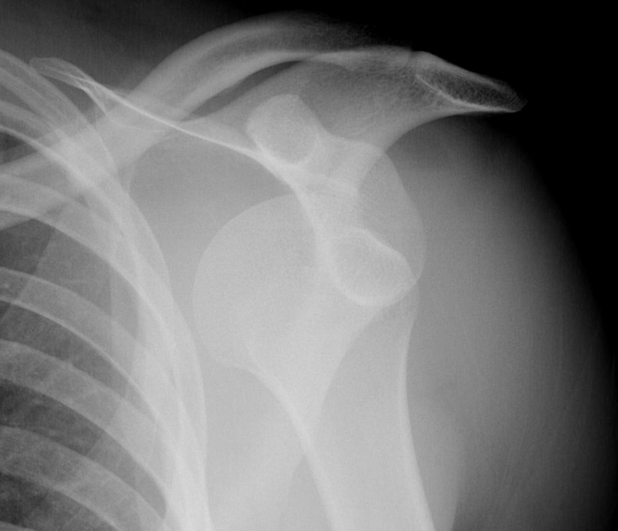 Anterior Shoulder Dislocation AP